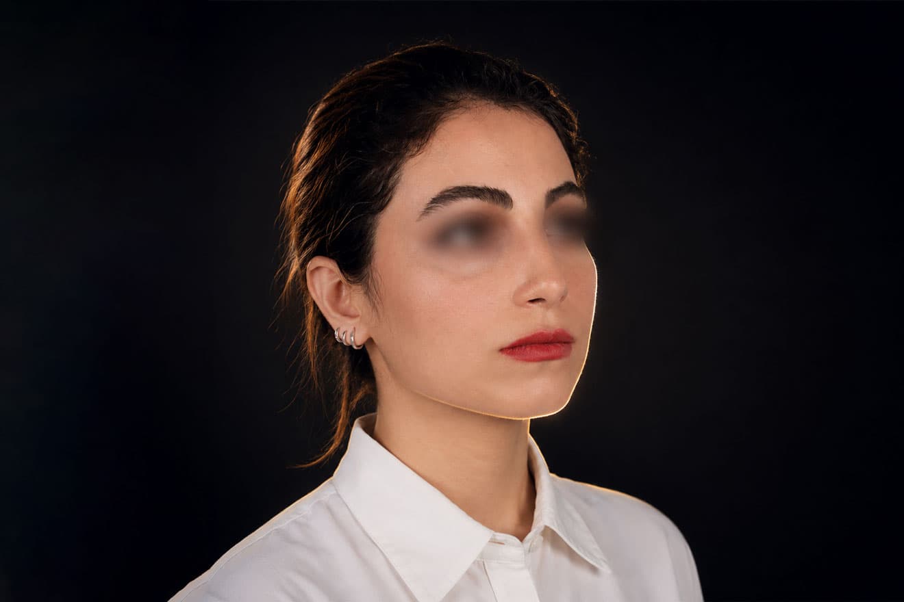 بینی غیرقرینه